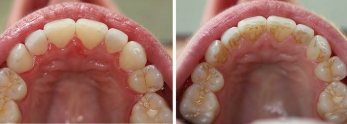 3 tipos de manchas dentales y cómo pueden tratarse con odontología estética