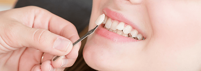 Diseno De Sonrisa Con Carillas Dentales 9 Preguntas Frecuentes