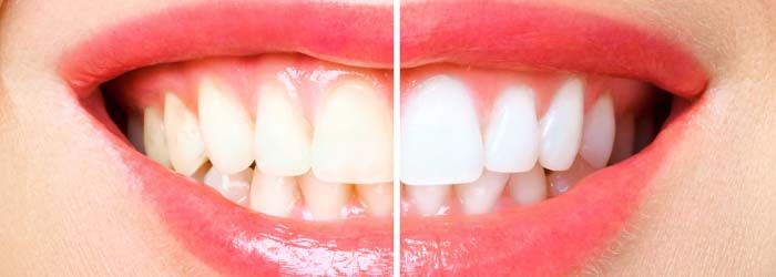 20211014 - Sakar Dental - antes-del-diseño-de-sonrisa