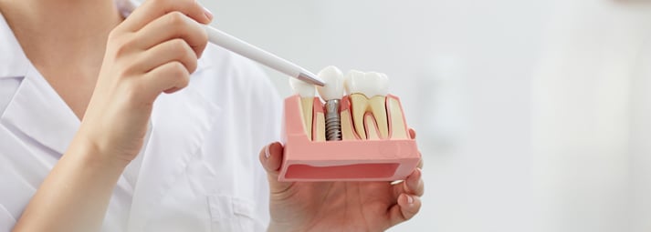 B3 Costo implante dental en México