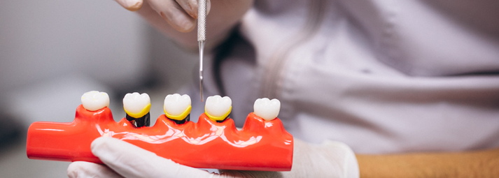 Beneficios implantes dentales