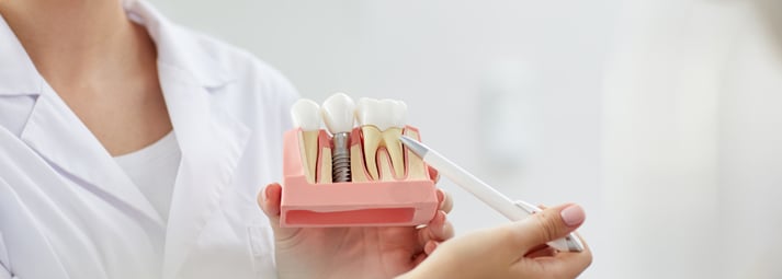 Duración coronas dentales en méxico