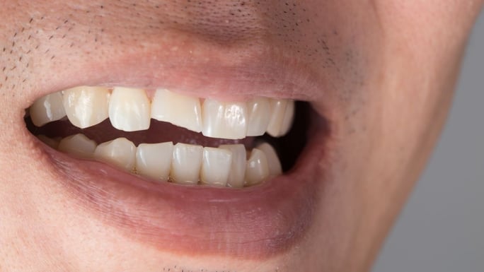 Sakar Dental Fracturas