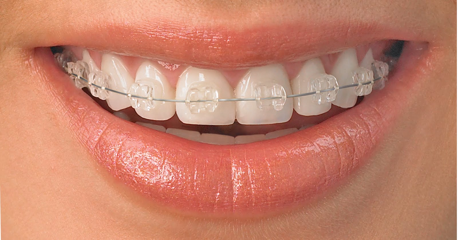 Sakar-dental-brackets