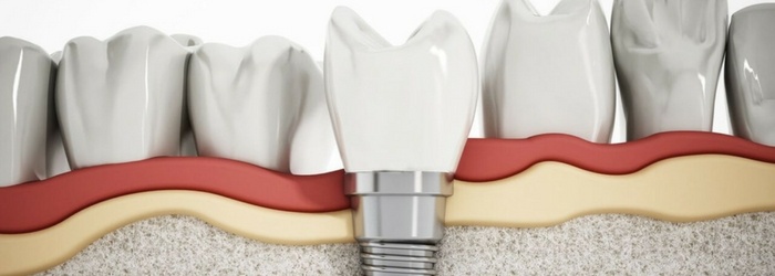 Fracaso De Los Implantes Dentales 6 Causas Principales 1123