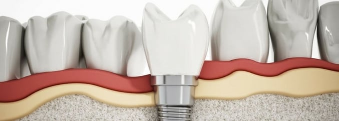 odontologia-integral-fracaso-implantes-dentales-7-causas.jpg