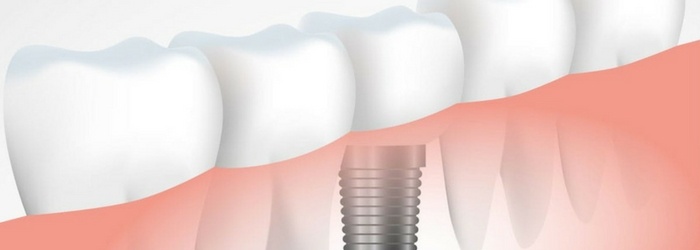 como-cuidar-implantes-dentales-4-pasos-importantes.jpg