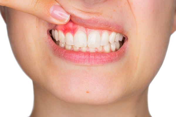 periodontitis-encias-inflamadas