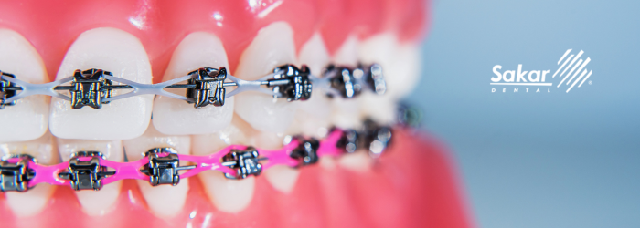 tipos-de-brackets-y-precio
