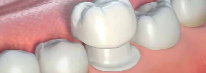 ¿Qué tipo de corona dental te acomoda mejor?