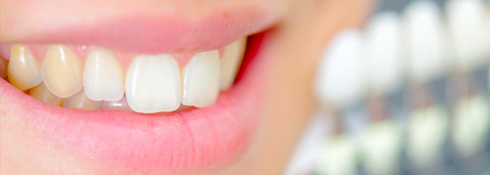 El uso de odontología estética para tratar 3 tipos de manchas en los dientes