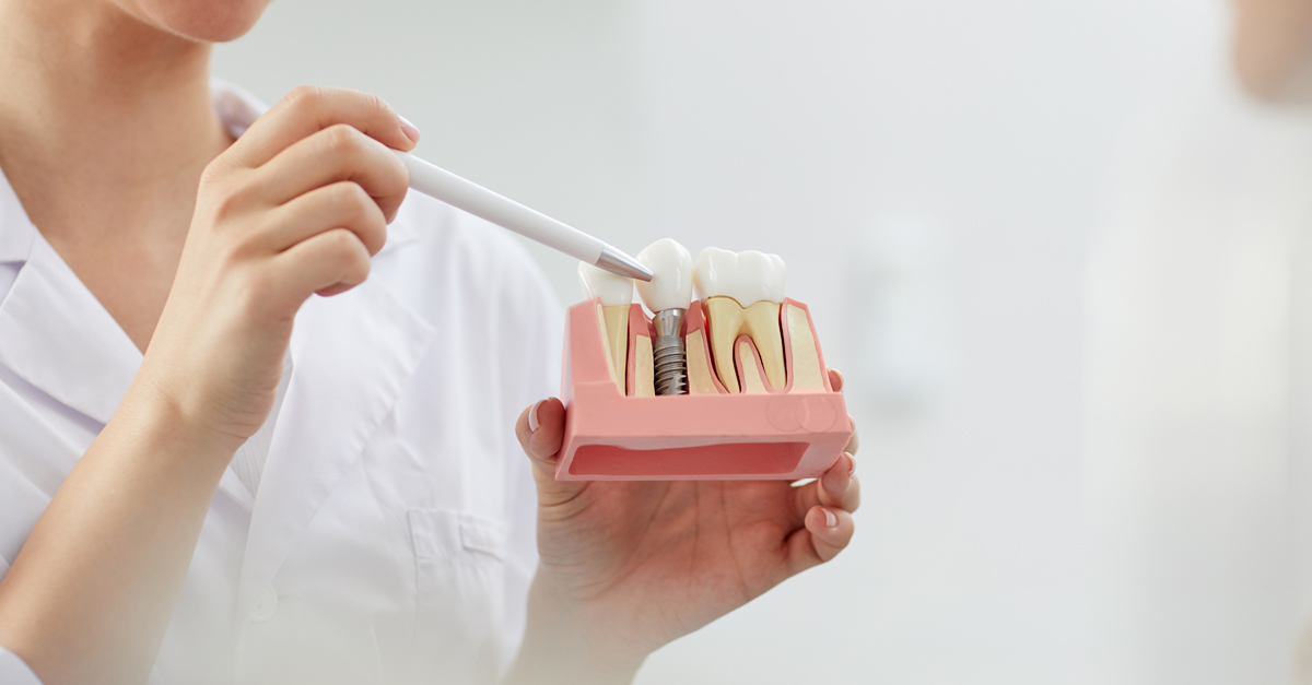 5 alimentos que puedes consumir después de tu implante dental