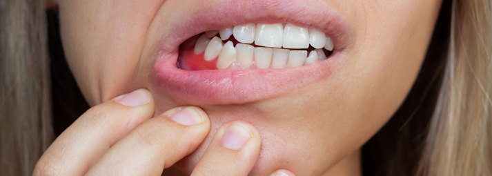 ¿Cómo evitar la periodontitis?