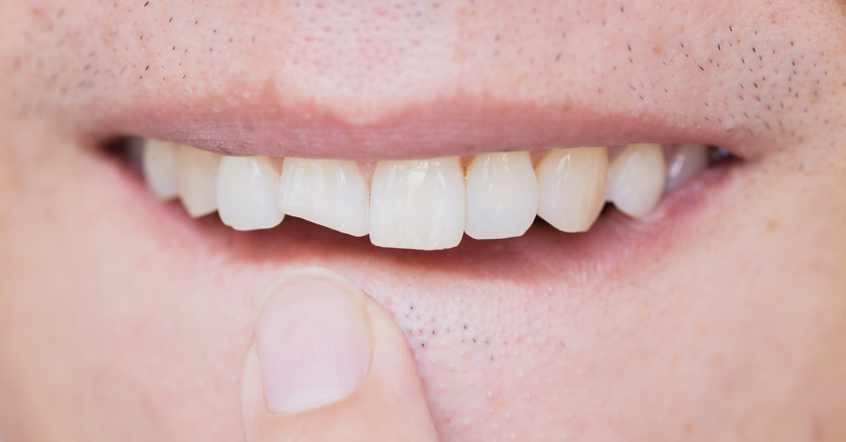 Conoce los tipos de fracturas dentales y sus tratamientos