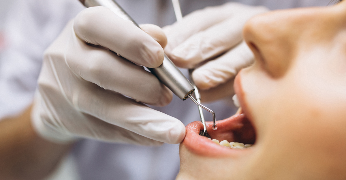 ¿Cuándo es el momento preciso para realizar una endodoncia?