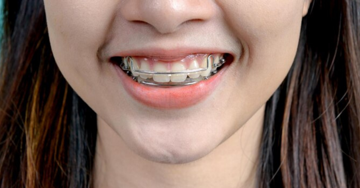 ¿Por qué usar retenedores dentales después de los brackets?
