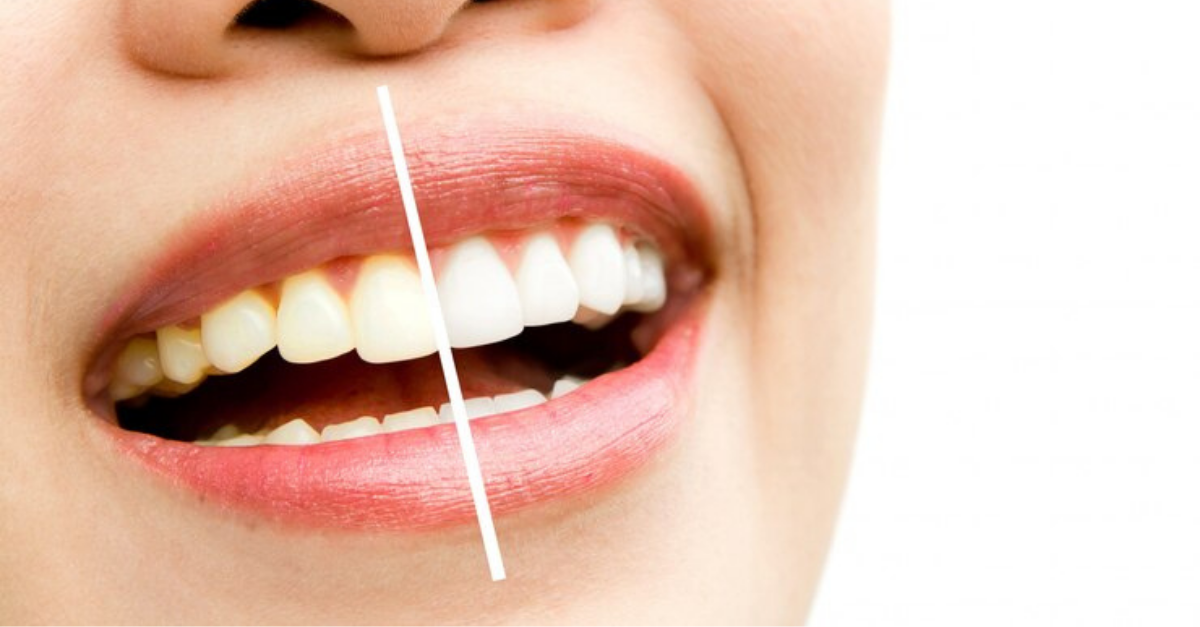 Tipos de blanqueamiento dental
