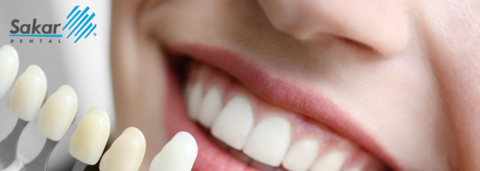 Carillas dentales vs. blanqueamiento dental: ¿cuándo elegir cada opción?