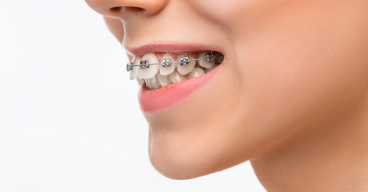 ¿Qué debe pedirte tu dentista antes de usar brackets estéticos?