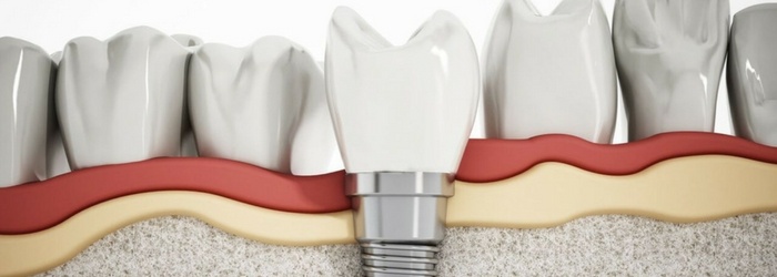 Fracaso de los implantes dentales: 6 causas principales