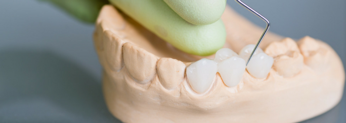 Rehabilitación oral: ¿cómo se realiza una prótesis dental (puente dental)?