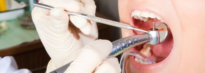 Cuidados después de una endodoncia