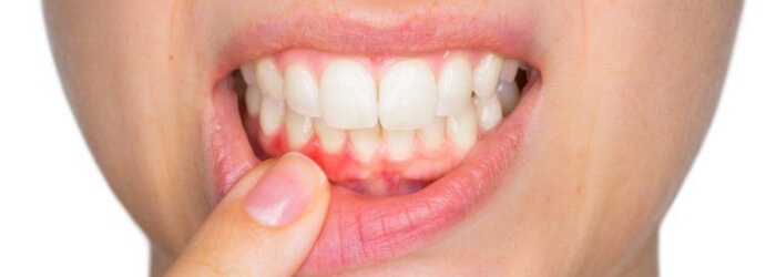 Gingivitis y periodontitis: cómo diferenciarlas y tratarlas