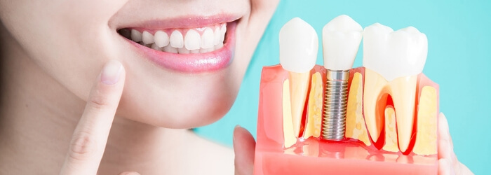 ¿Cómo se pone un implante dental?