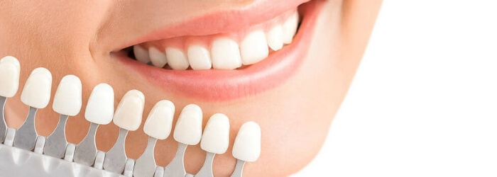 Problemas y riesgos de las carillas dentales mal colocadas