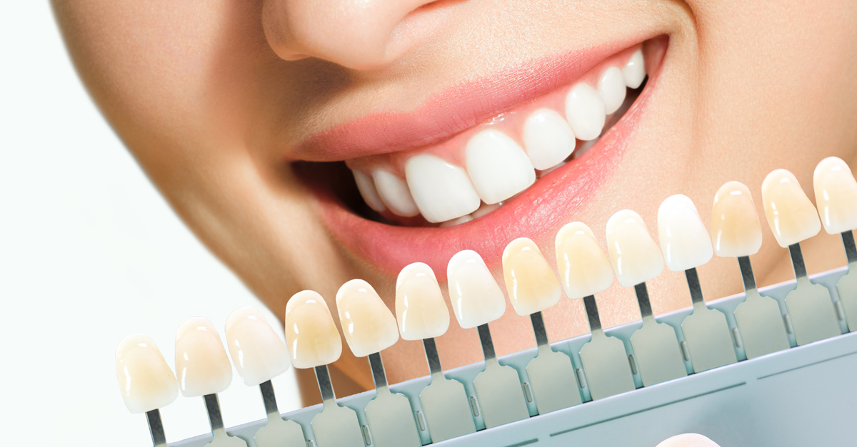 ¿Cómo se determina el tono adecuado para un blanqueamiento dental?