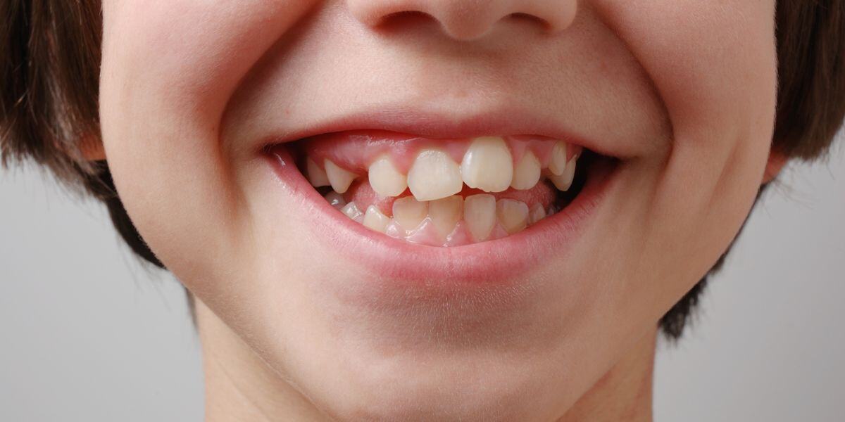 ¿Por qué a los niños les salen los dientes chuecos y cómo corregirlos a tiempo?