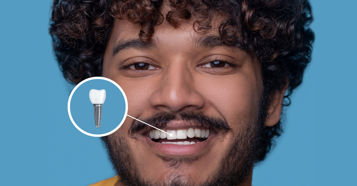 ¿Cuánto dura un implante dental?